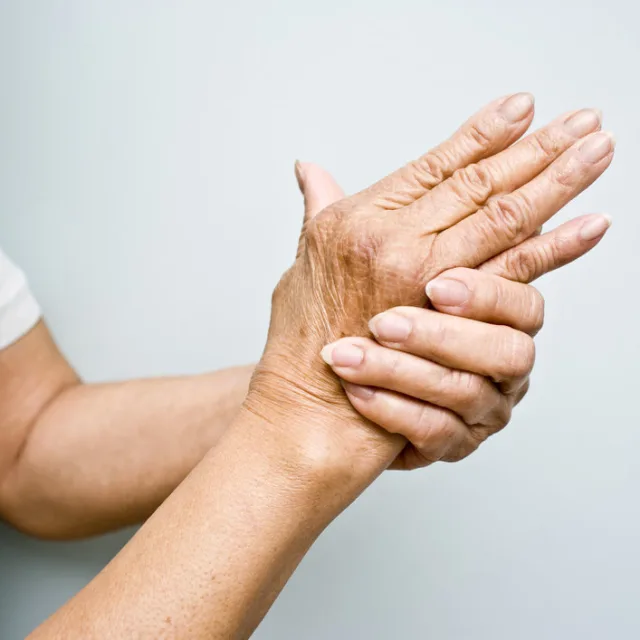 Dupuytren’s Disease